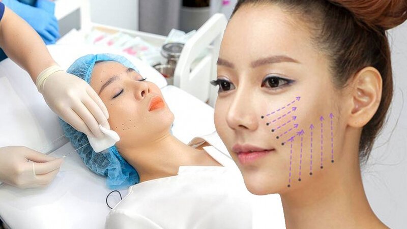 Căng chỉ trẻ hoá gương mặt - Phương pháp làm đẹp được ưa chuộng (Nguồn: Internet)