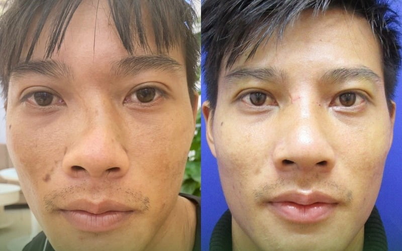 Chỉnh hình mũi do tai nạn (Nguồn: Thẩm mỹ MD Change Life)