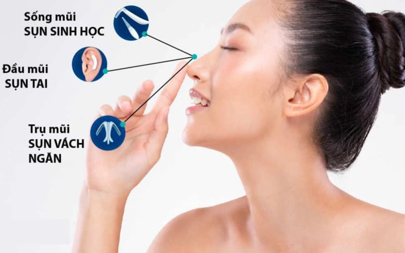 Cấy ghép sụn, chỉnh hình mũi (Nguồn: Internet)