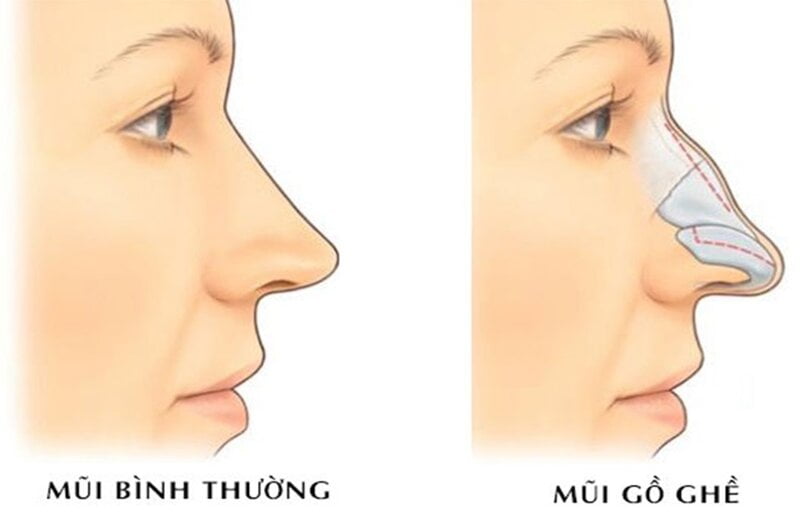 Mũi gồ khác mũi bình thường như thế nào? (Nguồn: Internet)