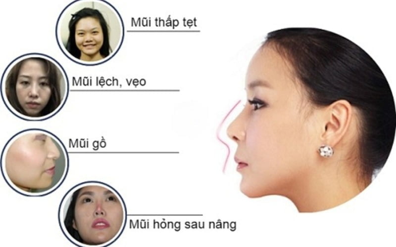 Nâng mũi cấu trúc 4D sở hữu nhiều ưu điểm vượt trội (Nguồn: Internet)