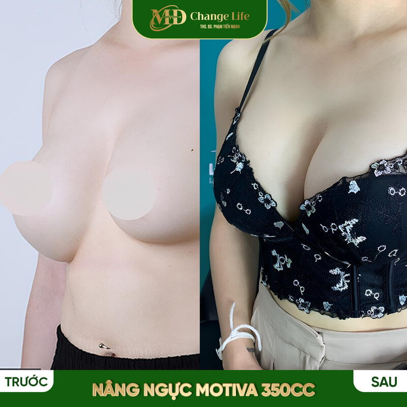 Nâng ngực an toàn, hiệu quả tại Thẩm mỹ MD Change Life (Nguồn: MD Change Life)