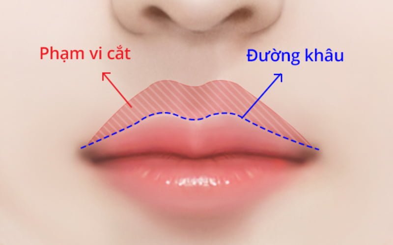 Phẫu thuật thu ngắn nhân trung là gì? (Nguồn: Internet)